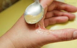 Dù bị bỏng nặng đến đâu, thực hiện sơ cứu theo cách này sẽ khỏi