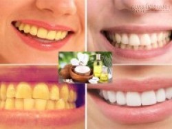 Loại bỏ mảng bám và ố vàng trên răng chỉ bằng dầu dừa