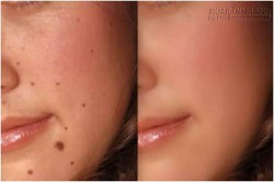 Tự tẩy nốt ruồi ngay tại nhà – đảm bảo hết chỉ với muối