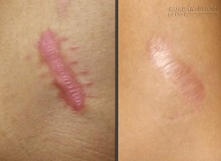 Vết sẹo lồi cứng đầu cũng phải bó tay vì rau má và ngải đắng