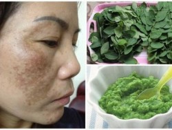 Cả tuần chỉ với mớ rau ngót 4 ngàn đồng, nám da trên mặt hết hoàn toàn