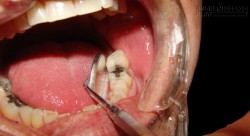 Những bài thuốc tại nhà trị chứng đau tủy răng