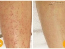 Trị dứt điểm viêm lỗ chân lông sau 7 ngày với bí quyết dễ không tưởng
