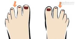 Xem tướng ngón chân đoán tính cách và vận số giàu nghèo