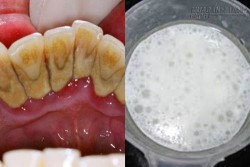 Chỉ cần chà hỗn hợp này lên răng, mảng bám, ố vàng sẽ không còn đường quay trở lại