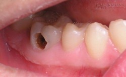 99% những người có răng khôn như thế này sẽ để lại hậu quả đáng sợ!