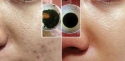 Hết sẹo rỗ ngay sau 1 tuần không để lại thâm nhờ rau má
