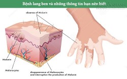 Nắm được mọi thông tin sau, bạn không cần lo lang ben sẽ ghé thăm