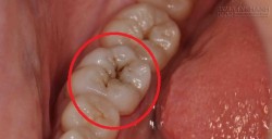Tuyệt chiêu trị đau răng hiệu quả với 3 nguyên liệu tự nhiên