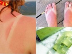 Tuyệt chiêu hô biến làn da cháy nắng thành trắng hồng sau nghỉ lễ