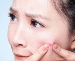Mẹo chữa sẹo thâm hiệu quả từ những thứ đơn giản