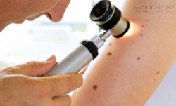 Nốt ruồi cảnh báo sức khỏe