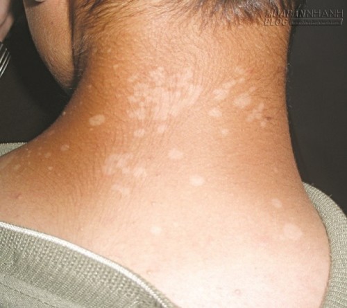 Nắng n&oacute;ng, ph&ograve;ng bệnh cho da