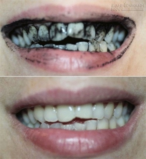 Mẹo làm trắng răng bằng than, chuyện thật như đùa