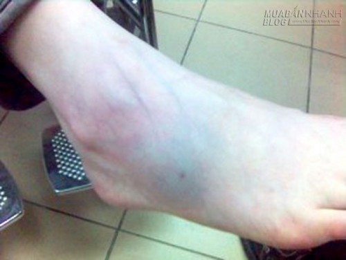 16 mẹo hay trị bong gân cực hiệu quả bạn nên biết