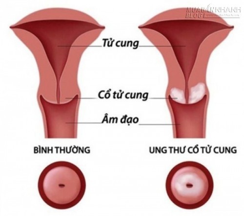 Nếu bạn có những thói quen dưới đây, hãy dừng lại ngay để tránh bị ung thư nhé