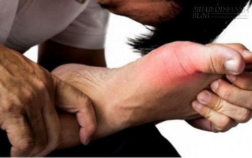 Tôi đã chiến thắng bệnh Gout chỉ bằng lá trầu và nước dừa