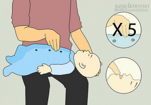 Xử trí gấp khi trẻ hóc dị vật
