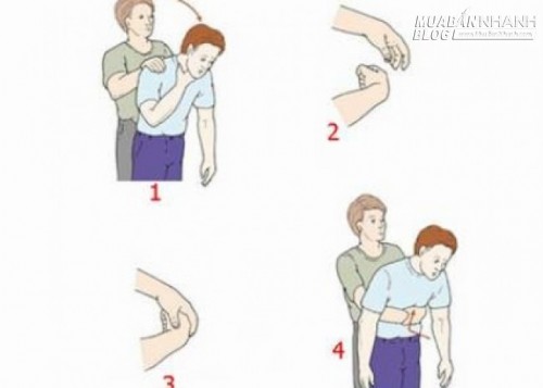 Xử trí gấp khi trẻ hóc dị vật