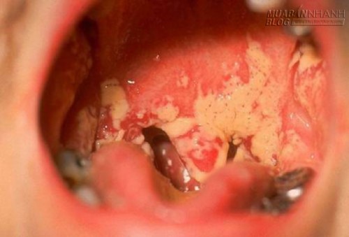 Đắng lòng thanh niên rước lậu vào thân từ trào lưu hôn gái lạ