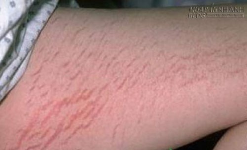 Loại bỏ vết rạn da bằng những cách vô cùng đơn giản