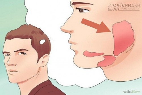 Căn bệnh nguy hiểm mắc một lần có thể vô sinh cả đời