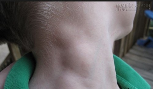 Nổi hạch trên người – biểu hiện của ung thư rất nguy hiểm