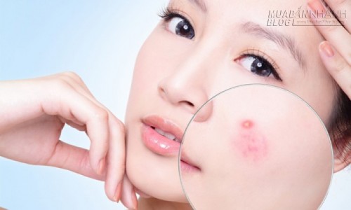 7 cách ngừa mụn hiệu quả