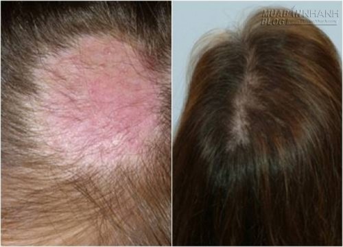 Chỉ cần thoa bia và trứng gà, tóc sẽ hết rụng và mọc nhanh như nấm