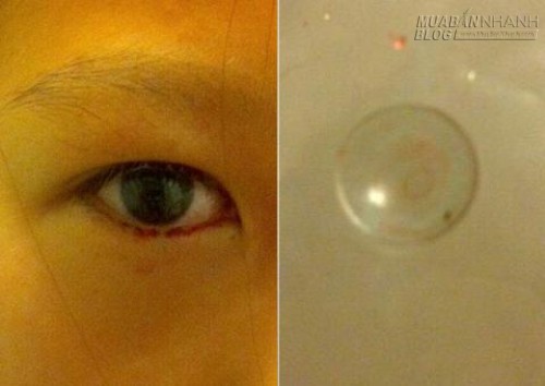 Cô bé 11 tuổi khóc ra máu vì đeo kính áp tròng suốt 2 năm