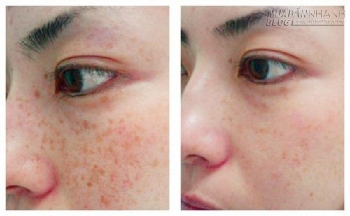 Nám nhiều và lâu năm đến đâu cũng bị xóa nhòa 90% nhờ đậu phụ non