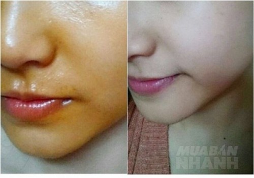 Sẹo th&acirc;m chi ch&iacute;t sẽ trắng b&oacute;c như g&aacute;i 18 nhờ chăm chỉ đắp thứ n&agrave;y 1 ph&uacute;t mỗi ng&agrave;y