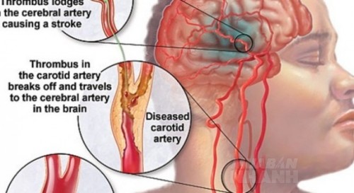 Lá ớt Bài thuốc quý cứu sống người bị tai biến trong vòng 1 phút