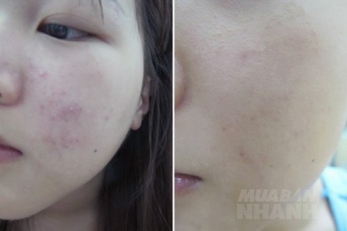 Bôi thứ nước chanh ngâm này chỉ 1 tuần mà mụn ẩn, mụn li ti bay sạch, da hồng hào thấy rõ