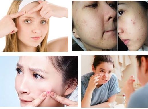 5 điều bố mẹ cần lưu ý để giúp con thoát mụn