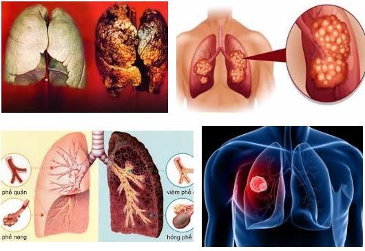 Ung thư phổi – căn bệnh không chỉ riêng người hút thuốc lá