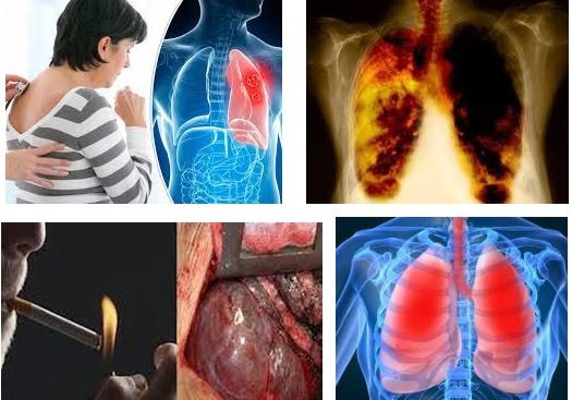 6 dấu hiệu nhận biết ung thư phổi đang ghé thăm cơ thể bạn