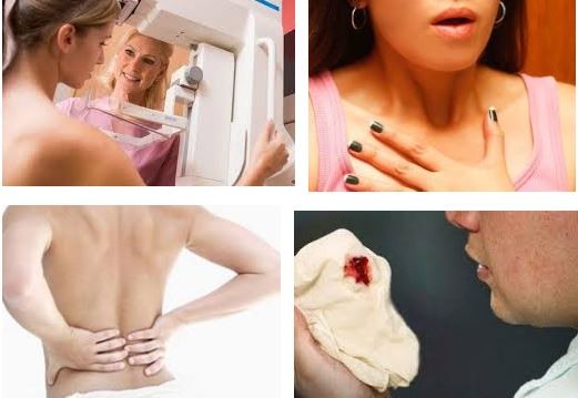 Các khối u ép trên tĩnh mạch lớn vượt qua phần trên của phổi phải có thể gây ra tắc nghẽn mạch máu
