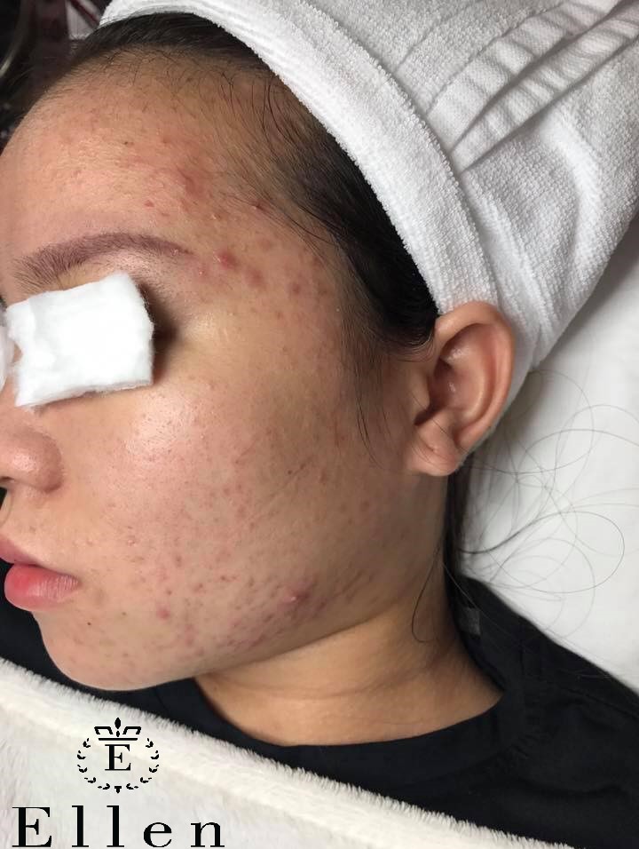 Mụn bọc là gì?