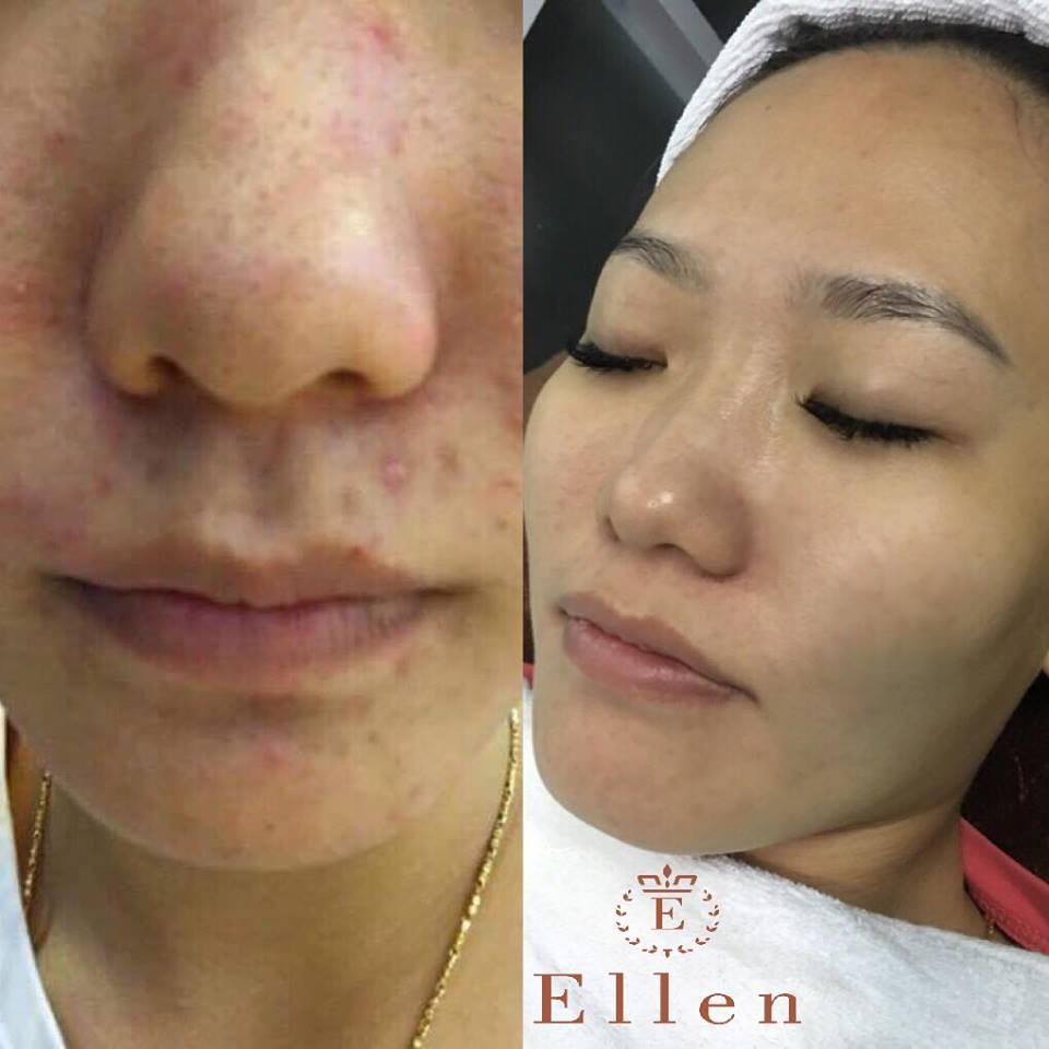 Mụn bọc là gì?
