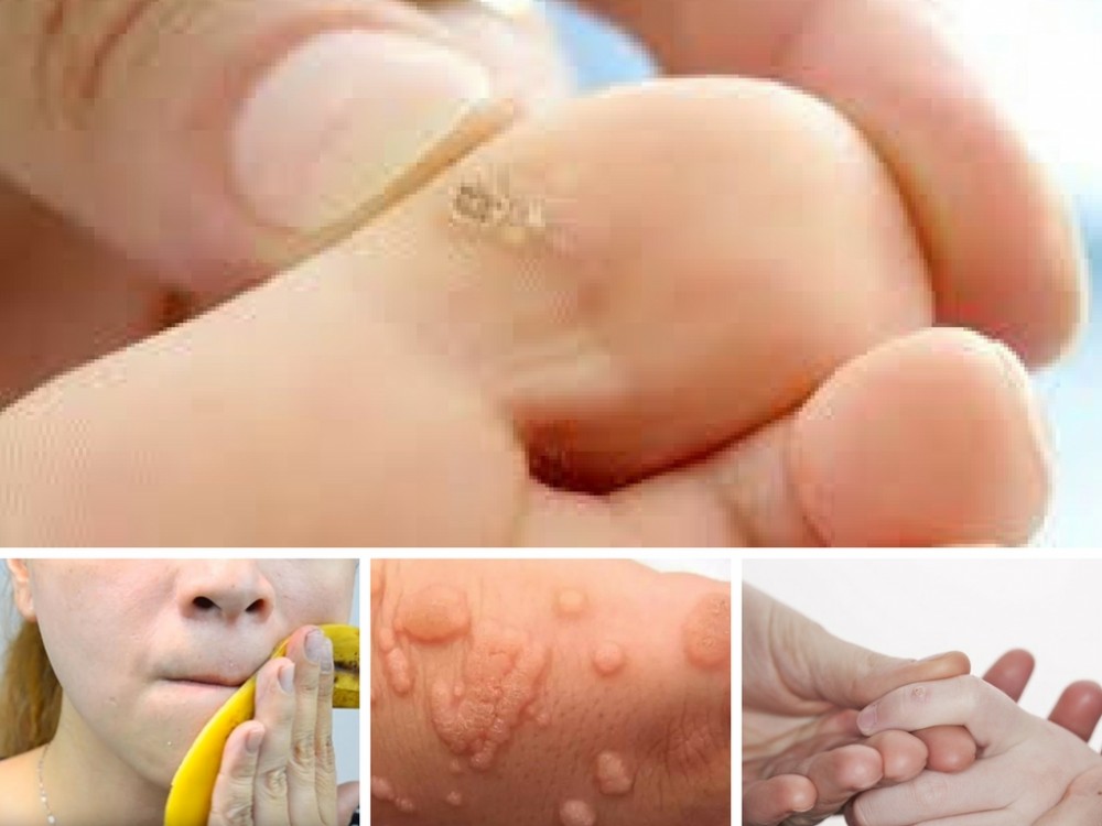 Mụn cóc là gì? Nguyên nhân và cách phòng chống mụn cóc