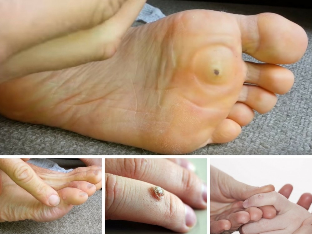 Mụn cóc là gì? Nguyên nhân và cách phòng chống mụn cóc