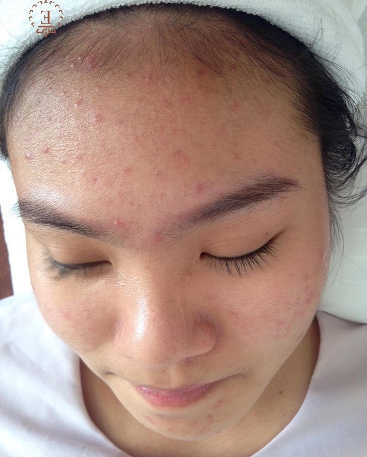 Lấy nhân mụn ở đâu tốt