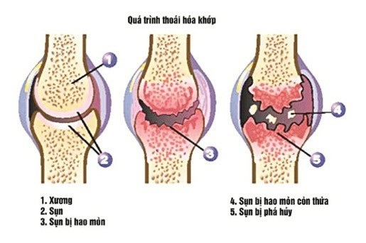 Những dấu hiệu nhận biết Thoái hóa khớp