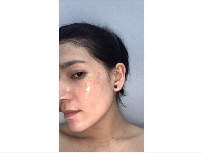 Cách trị mụn hiệu quả cho da dầu(1)