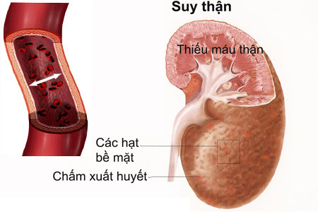 Thận ảnh hưởng tới sinh lý ở nam giới