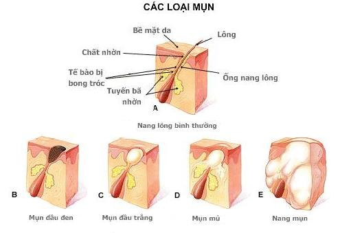 Tác hại của mụn như thế nào đến cuộc sống của bạn?