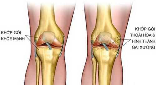 Cách phòng ngừa và điều trị đau khớp khi trời lạnh