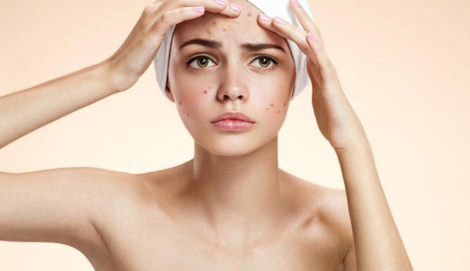 Trị mụn bằng Đông y có hiệu quả không?
