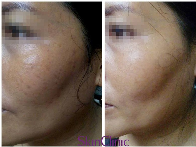 Những lưu ý khi lựa chọn spa trị nám, trị mụn